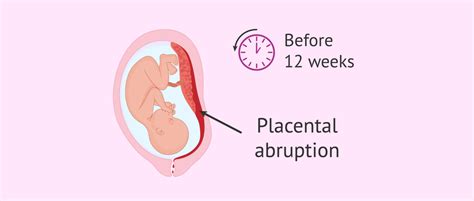 What is placental abruption?