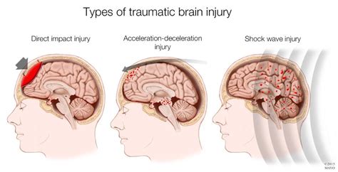 Traumatic Brain Injury Brain Injury Association Of Virginia