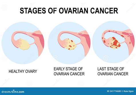 Ovarian Cancer Stages