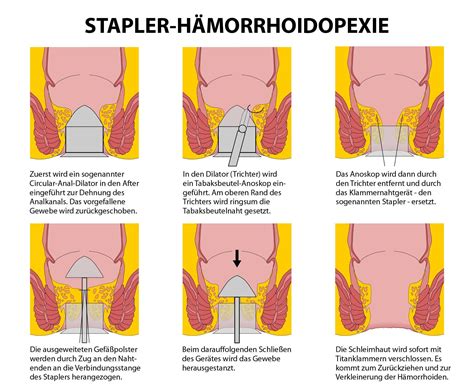 Wann Müssen Hämorrhoiden Operiert Werden