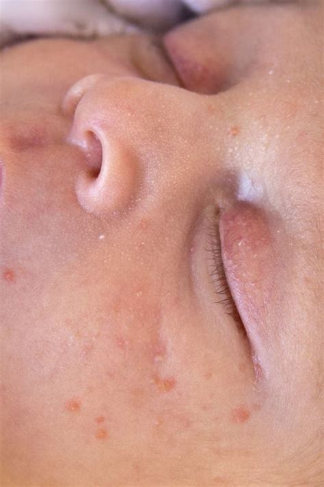 Causes And Treatments For Baby Acne