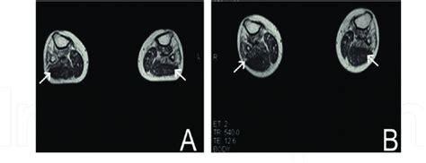 (A) MRI scan of lateral head of gastrocnemius (arrow) pre-cell therapy ...