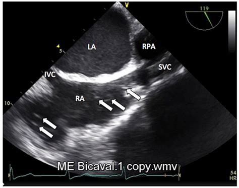 Air Embolism And Anaesthesia Wfsa Resources