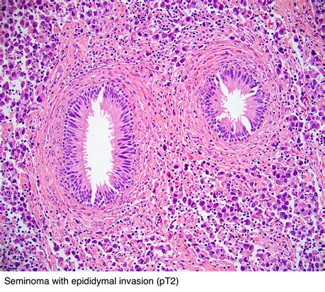 Pathology Outlines Seminoma