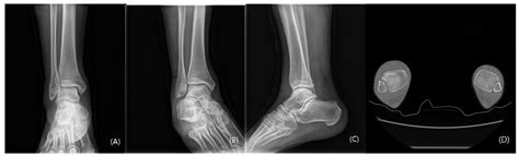 Maisonneuve Fracture