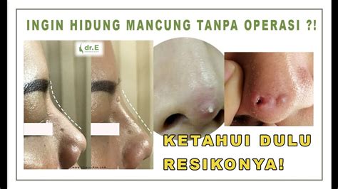 Resiko Tanam Benang Bikin Hidung Hancur Youtube