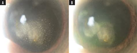 Treating Herpes Simplex And Varicella Anterior Uveitis Glaucoma Today