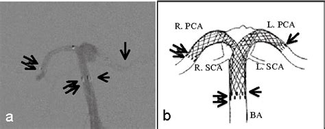 Figure From Y Configured Double Stent Assisted Coil Embolization With