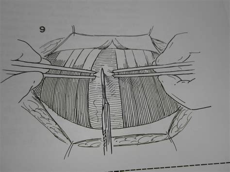 The Pfannenstiel Incision Opening And Closing The Tummy