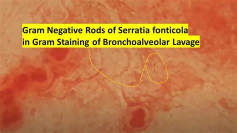 Gram Negative Rods Of Serratia Fonticola In Gram Staining Of Bronchoalveolar Lavage Youtube