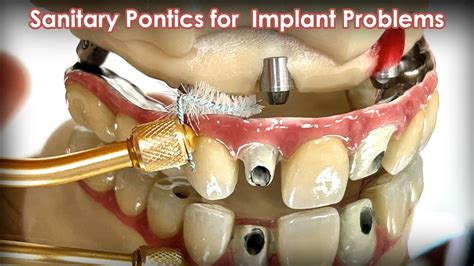 Creating Sanitary Pontic Bridges From Two Implant Problems YouTube