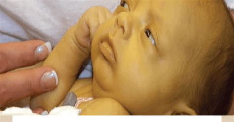 HOW DANGEROUS IS JAUNDICE FOR NEWBORN BABIES