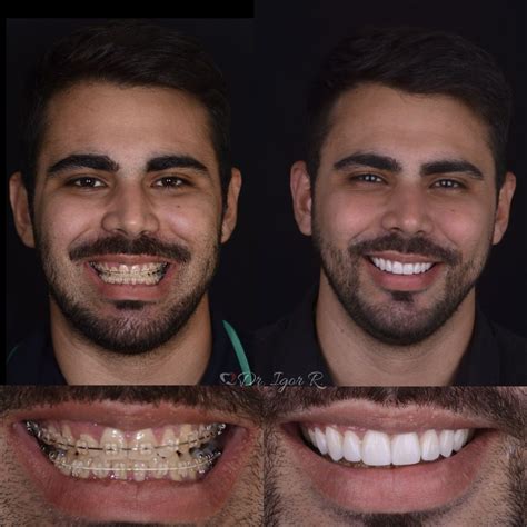 Lentes de Contato Dental em Fortaleza O que você PRECISA saber