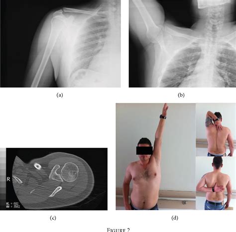 Figure 2 From Acromioclavicular Dislocation Associated With Coracoid Process Fracture Report Of