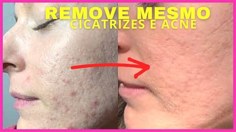 Cicatrizes De Acne Tratamento Para Remover Cicatrizes YouTube