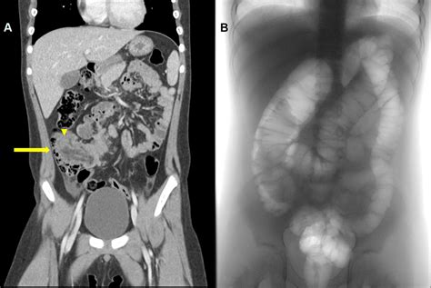 Endoscopic Management Of Failed Enema Reduction In Children With