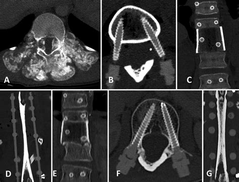 Sublaminar Bands In Oncological Spine Surgery Illustrative Cases In