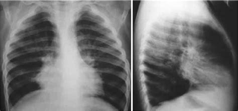 Bronchiolitis Obliterans | Thoracic Key