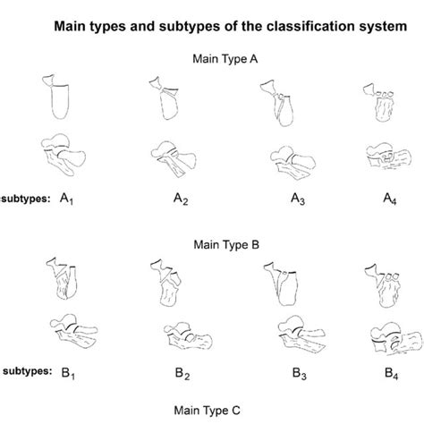 Diagram showed new intra-articular calcaneal fracture classification ...