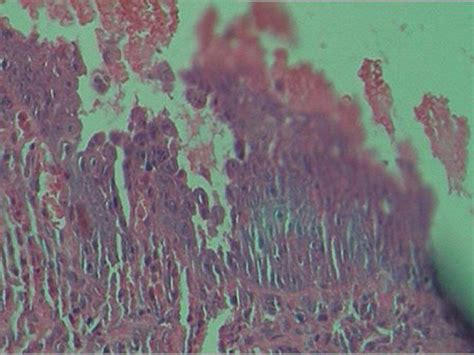 Pemphigus Vulgaris A Report Of Three Cases Bmj Case Reports