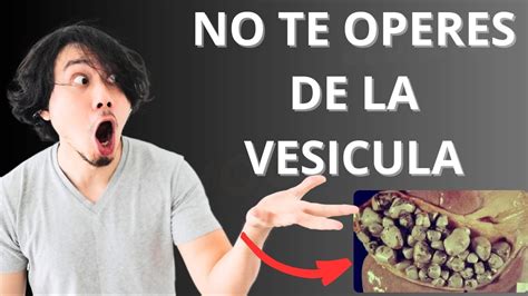 COMO Eliminar Las Piedras De La VESICULA Sin CIRUJIA REMEDIO Natural