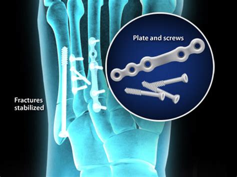 Video Fijación De Fractura Metatarsiana Reducción Abierta Y Fijación Interna Healthclips