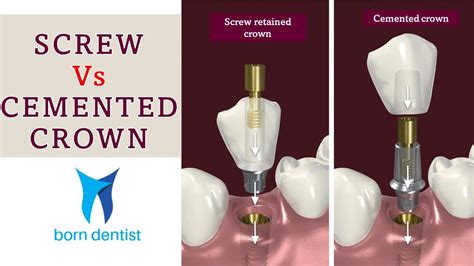 SCREW VS CEMENT RETAINED IMPLANT CROWN YouTube