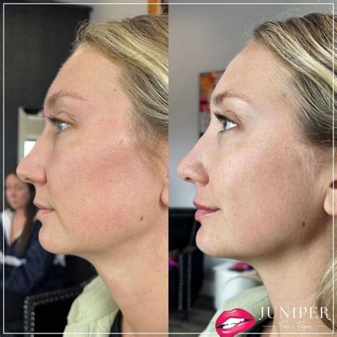 Before And After Archive Juniper Face Figure