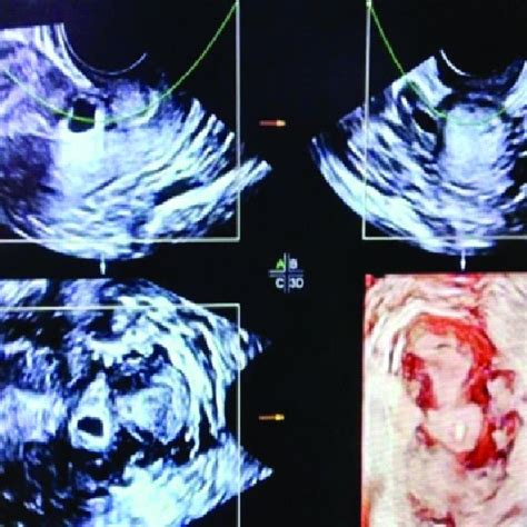 C Transvaginal Sonography Tvs Sagiial View Of The Uterus Showing The