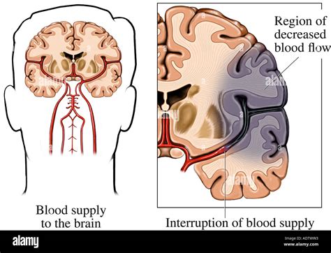 Ischemic Stroke Diagram