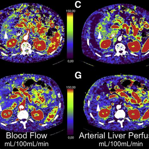 Radiological Hallmarks Of Hepatocellular Carcinoma Hcc Typical Download Scientific Diagram