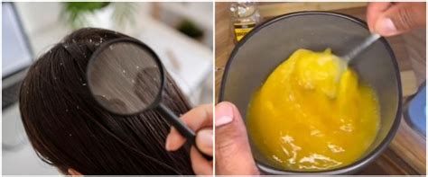 Rambut Bersih Tanpa Lemon Ini Cara Atasi Ketombe Akibat Kulit Kepala