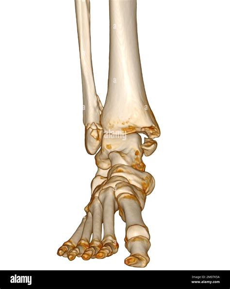 Tomografía computarizada de tobillo y pie o Tomografía computarizada de