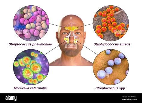 Rhinosinusitis In A Man And Bacteria That Cause Sinusitis