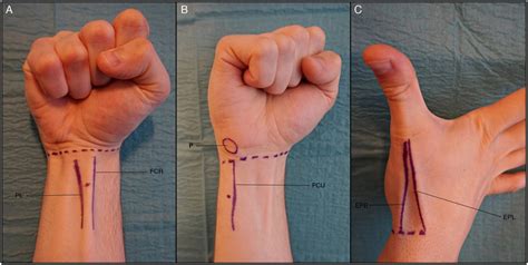 Em Didactic Wrist Block Landmark Technique