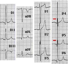 Ipertrofia Ventricolare Sinistra Ed E C G Rapido Riconoscimento Con