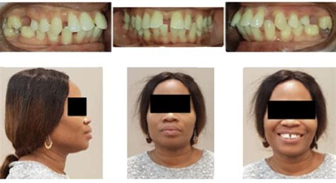 Orthodontic Alignment For Pre Prosthetic Treatment Aligner Concierge