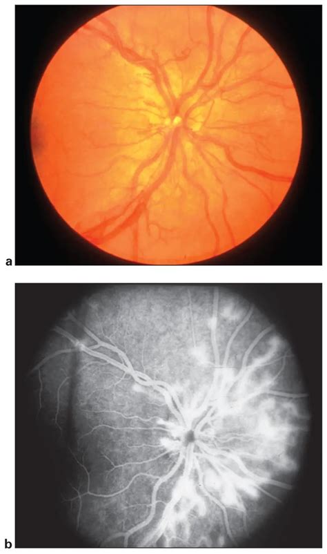 Pars planitis - American Academy of Ophthalmology