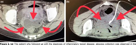 PDF Percutaneous Drainage As An Rapid Procedure For Deep Pelvic