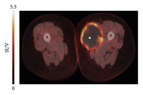 Example Of A Malignant Peripheral Nerve Sheath Tumor In The Adductor