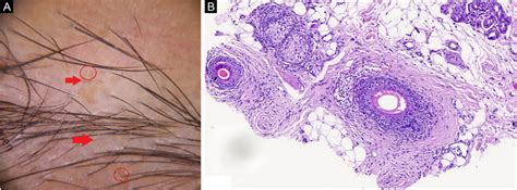 A Vellus Hairs Red Arrow Yellow Dots Red Circle B