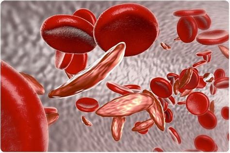 Sickle Cell Anemia Treatment Cost In India