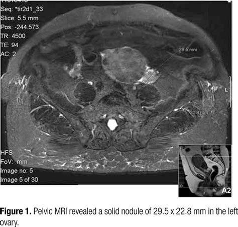 Ovarian Leydig Cell Tumor In A Post Menopausal Patient With Severe