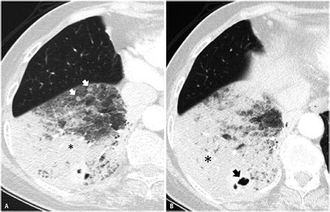 Prognosis For Pneumonic Type Invasive Mucinous Adenocarcinoma In A