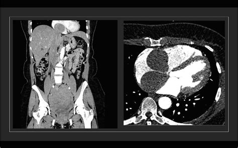 Figure From Multidisciplinary Approach To Pelvic Leiomyomatosis With