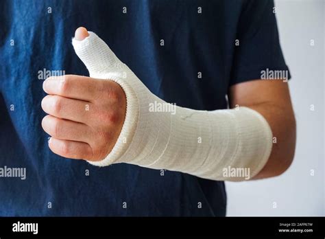 Man with plaster cast on broken hand, broken thumb,broken wrist Stock Photo - Alamy