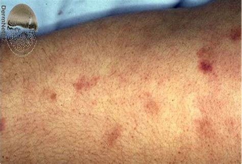 Vasculitis Test Your Knowledge