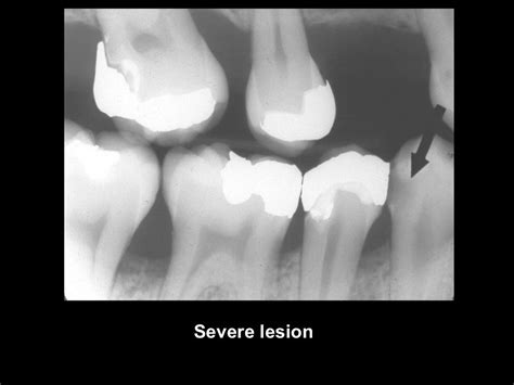 Radiographic Caries Diagnosis