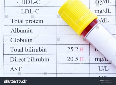 high bilirubin   images shutterstock