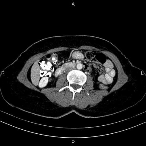 Radiopaedia Case Incomplete Annular Pancreas Id Study